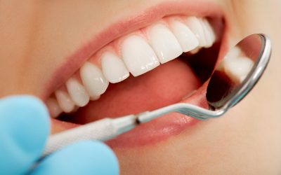 Albirea dintilor – totul despre estetica dentară
